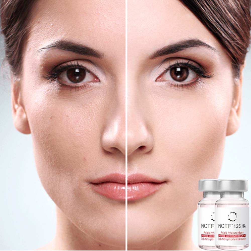 Intradermoterapia NCTF